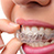 5 Reasons To Get Teeth Whitening Treatment